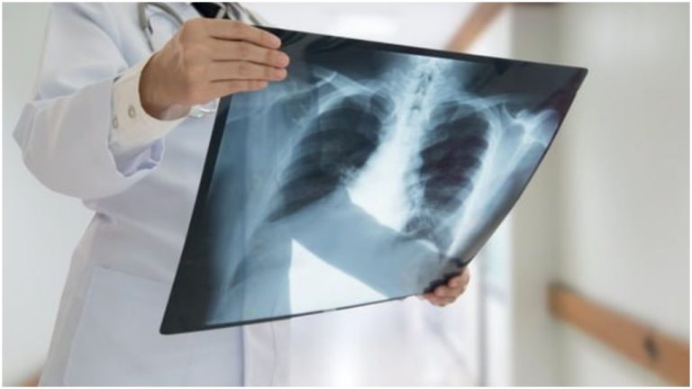 अब सीने के X-Ray से होगी Coronavirus से संक्रमित मरीज की पहचान, KGMU के हाथ लगी बड़ी सफलता