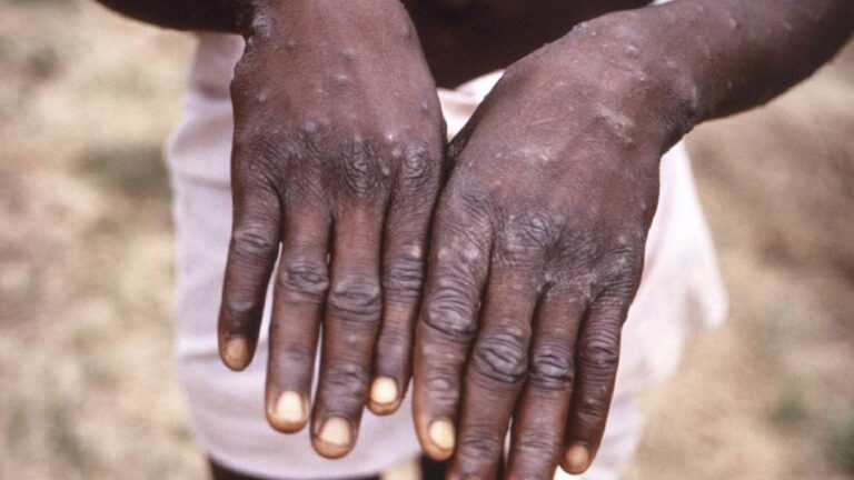 Kerala reports India’s second Monkeypox case : केरल में मिला देश का दूसरा मंकीपॉक्स का मरीज, बढ़ी चिंता